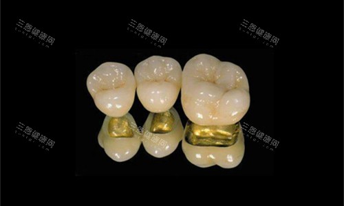 各类金属烤瓷牙展示图