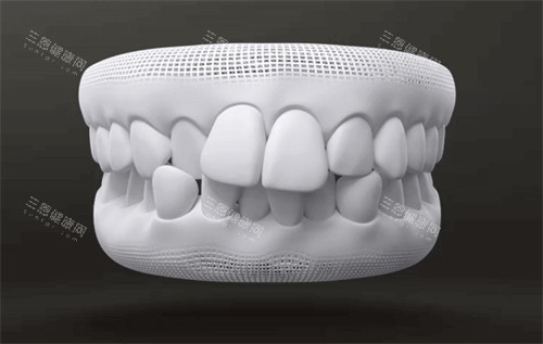 階形牙套同傳統鋼牙箍牙結果係咪一樣？專業牙醫拆解兩者原理同實際结果差異