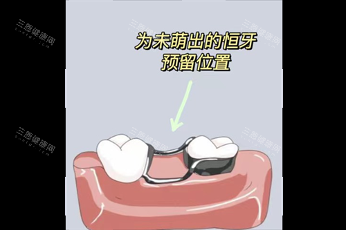 牙齿间隙保持器