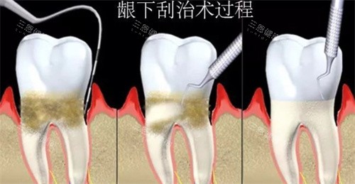 龈下刮治过程