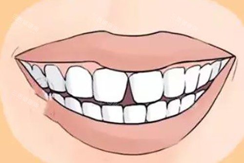 喷砂洗牙同拋光洗牙有咩分別？邊種方法去牙菌斑更勁？