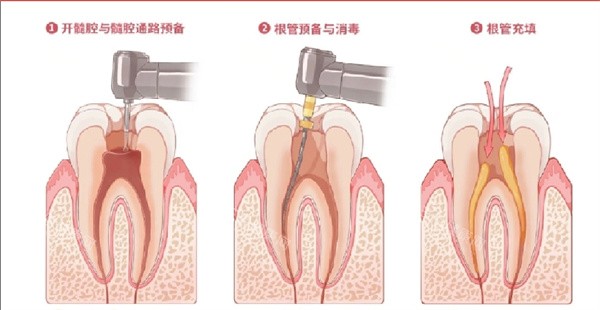 根管治疗展示