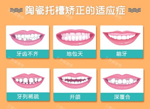 陶瓷半隐形矫正适应症