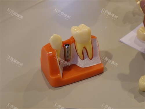 香港人在深圳看牙齒貴嗎？真實體驗話妳知！種植牙、牙齒矯正、補牙、拔牙、杜牙根等牙科項目揭曉！
