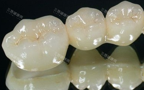 牙橋牙套收費標準大公開！瓷牙套牙橋、鑲牙價格全解析