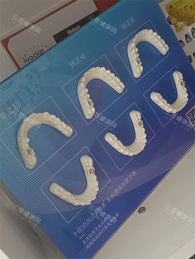 點解牙醫唔建議我做隱形箍牙？5種唔啱用隱形牙套嘅牙齒問題大揭秘！