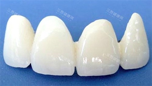 全瓷牙修復牙齒缺損：啱唔啱你？同傳統方法比一比先知！