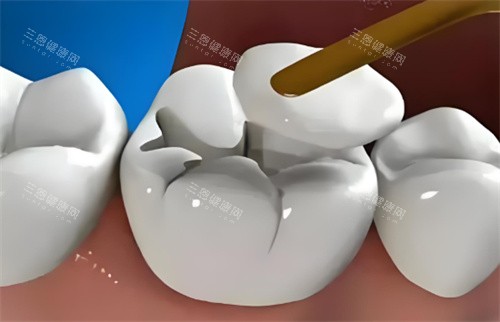 补牙材料点拣？牙医图解：$50块补牙可能1年就甩（附材质寿命表）