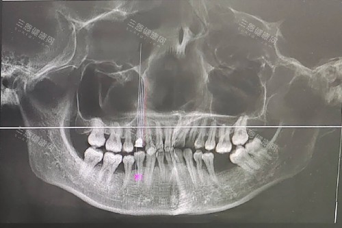 牙周病治疗3大误区！良心牙医踢爆：一次起效 可能伤牙根（附疗程表）