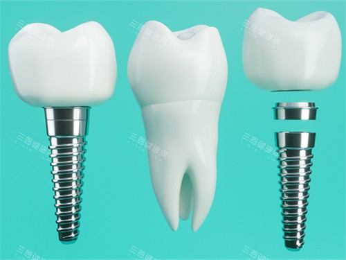 香港種植牙同深圳種植牙邊個好？香港種植牙價格同深圳種植牙價格一樣嗎？