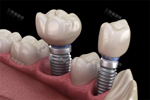 种植牙动画图示 种植牙动画图示