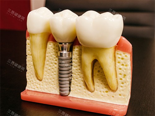 种植牙模型图 种植牙模型图