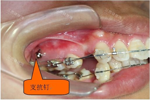牙齿矫正骨钉种植钉口腔示意图