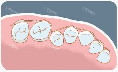 牙齿矫正漫画牙齿图 牙齿矫正漫画牙齿图
