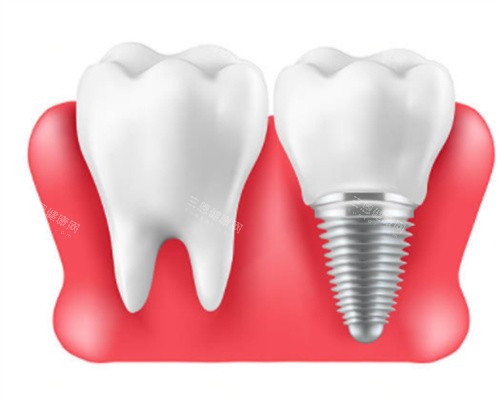 自然牙和种植牙 自然牙和种植牙