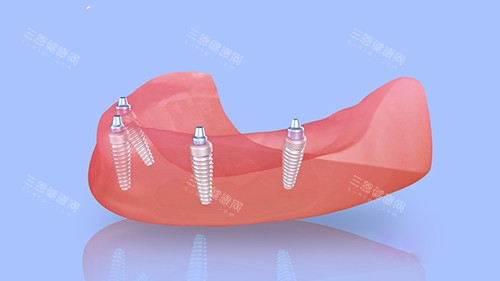 深圳希奧口腔是正規的嗎？是的，深挖醫院資質|醫生技術|收費標準|口碑發現都正規