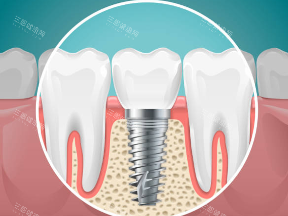 深圳華誠博雅口腔種牙收費係點？有冇詳細價格表？做種植牙到底多少錢先至夠？