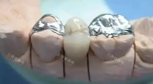 瓷倍健全瓷牙是國產還是進口？國產中高端檔次全瓷牙，材料|價格|口碑解析