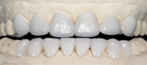瓷倍健全瓷牙多少錢一顆？分享瓷倍健全瓷牙價格表、所屬檔次、材質及維持時間
