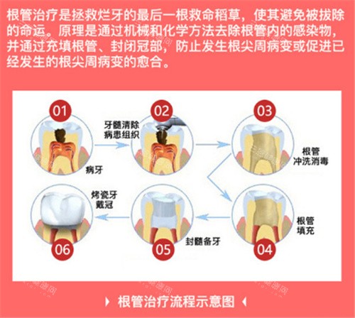 根管治疗流程展示