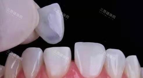 铸瓷材料贴片 铸瓷材料贴片