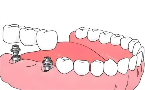 种植牙材料卡通展示图 种植牙材料卡通展示图