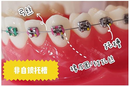 香港牙齒矯正幾多錢？想整牙嘅寶子唔好瞎猜價錢！金屬/隱形/隱適美收費標準喺呢度