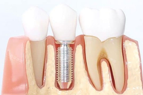 单颗种植牙模型图