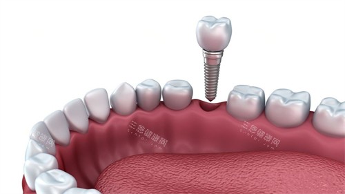 单颗种植体图示 单颗种植体图示