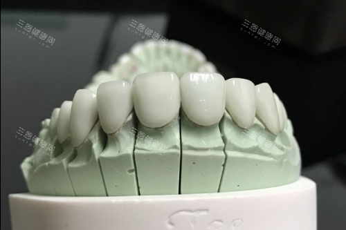 全瓷冠牙齦萎縮？原因同應對方法話你知