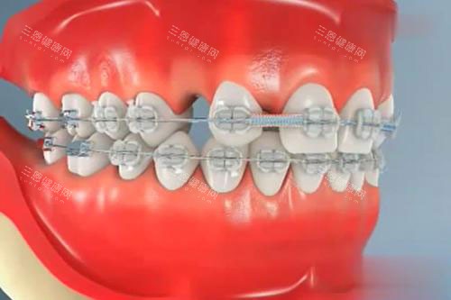 牙齿矫正模型漫画 牙齿矫正模型漫画