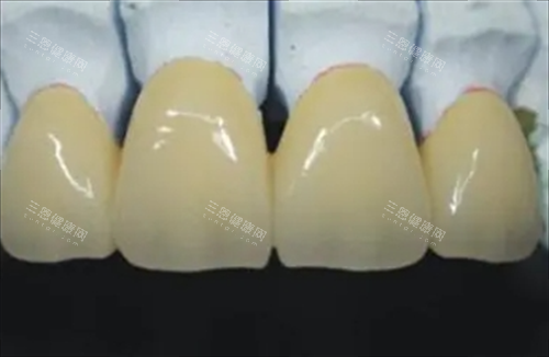 钯金烤瓷牙展示 钯金烤瓷牙展示