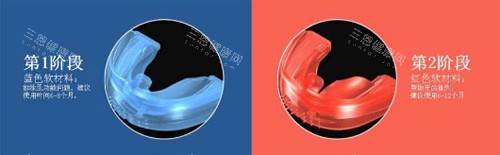 罗慕矫治器不同阶段图示 罗慕矫治器不同阶段图示