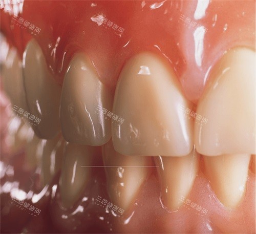 深圳整吸附性義齒邊間牙醫好？呢幾間牙科老牌服務技術掂，值得信賴！