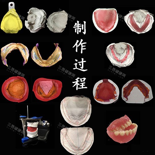 吸附性义齿制作过程示意图 吸附性义齿制作过程示意图