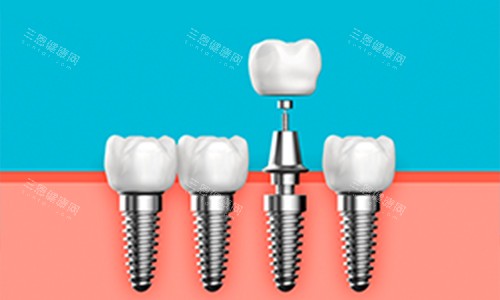 深圳全口种植牙价钱揭秘！究竟要使几钱？