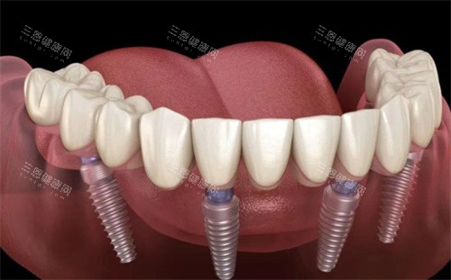 全口种植牙 全口种植牙