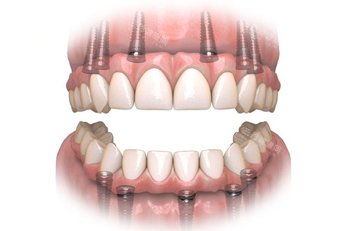 all-on-6全口种植牙示意图 all-on-6全口种植牙示意图