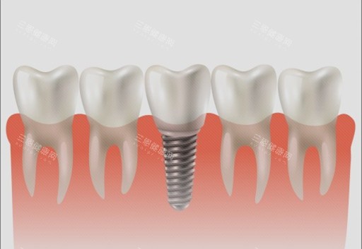 深圳萬豐醫院口腔種植牙價格表好詳細！想知做種植牙多少錢、種牙收費如何？呢度一目了然夠晒清晰！