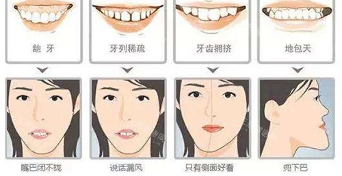 牙齿矫正脸型变化适应症 牙齿矫正脸型变化适应症