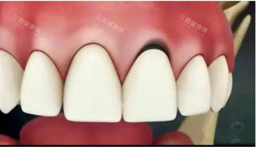 烤瓷牙能做牙齒矯正嗎？正規牙醫告訴你修復牙與矯正的兼容性問題！
