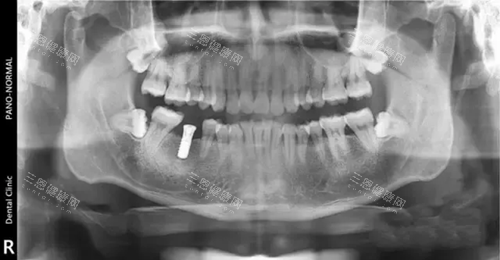 種植牙材質比較好的是哪個地區？瑞士、韓國、德國，到底哪家強？