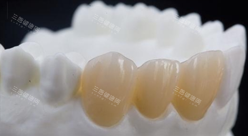 種植牙VS全瓷牙哪個更好？從使用壽命、價格、舒適度全方面對比分析！
