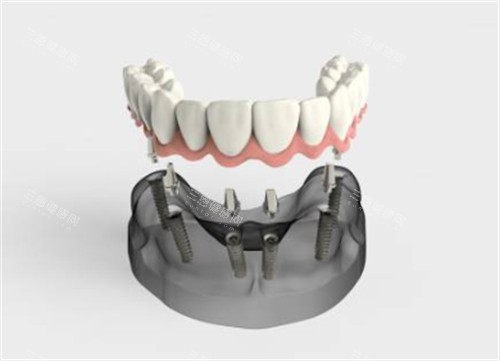 All-on-4植牙費用香港篇：半口15萬起vs深圳5萬起價差破10萬，港人北上植牙成現在熱門選擇！