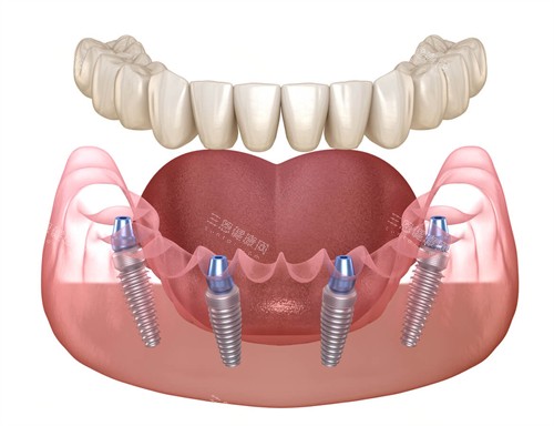 半口种植牙动画图示 半口种植牙动画图示