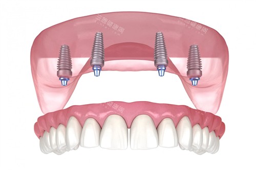 半口种植体展示 半口种植体展示