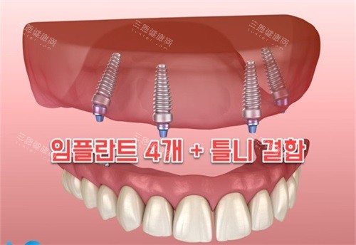 种植牙半口漫画示意图 种植牙半口漫画示意图