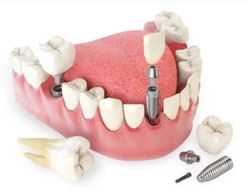 深圳尚佳口腔價目表震撼發布：種植牙低至2980+、牙齒美白480+、補牙88+