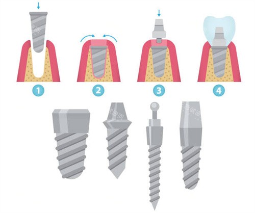 香港種植牙價格2025全攻略！單顆/半口/全口費用公開+避坑指南