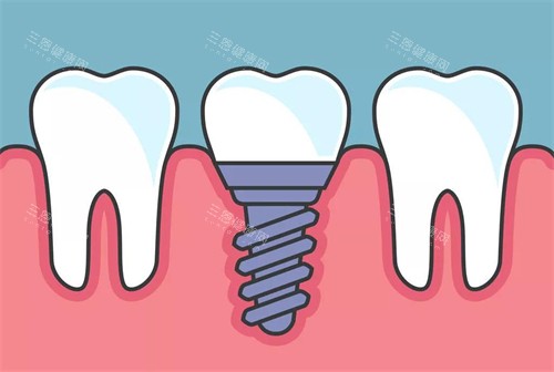 种植牙植入后漫画示意图 种植牙植入后漫画示意图